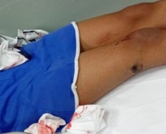 Menina de 10 anos é atropelada por moto a caminho da escola em Colatina
